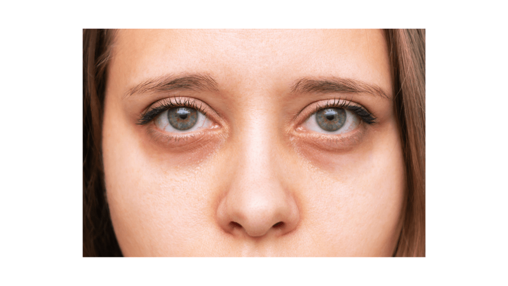 dark circle eyes
